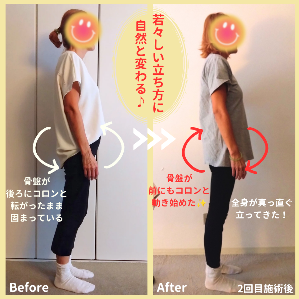 骨盤のクセ、before＆after